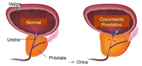 tumor benigno prostata operacion