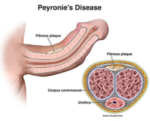 Enfermedad de Peyronie (Curvatura del pene)