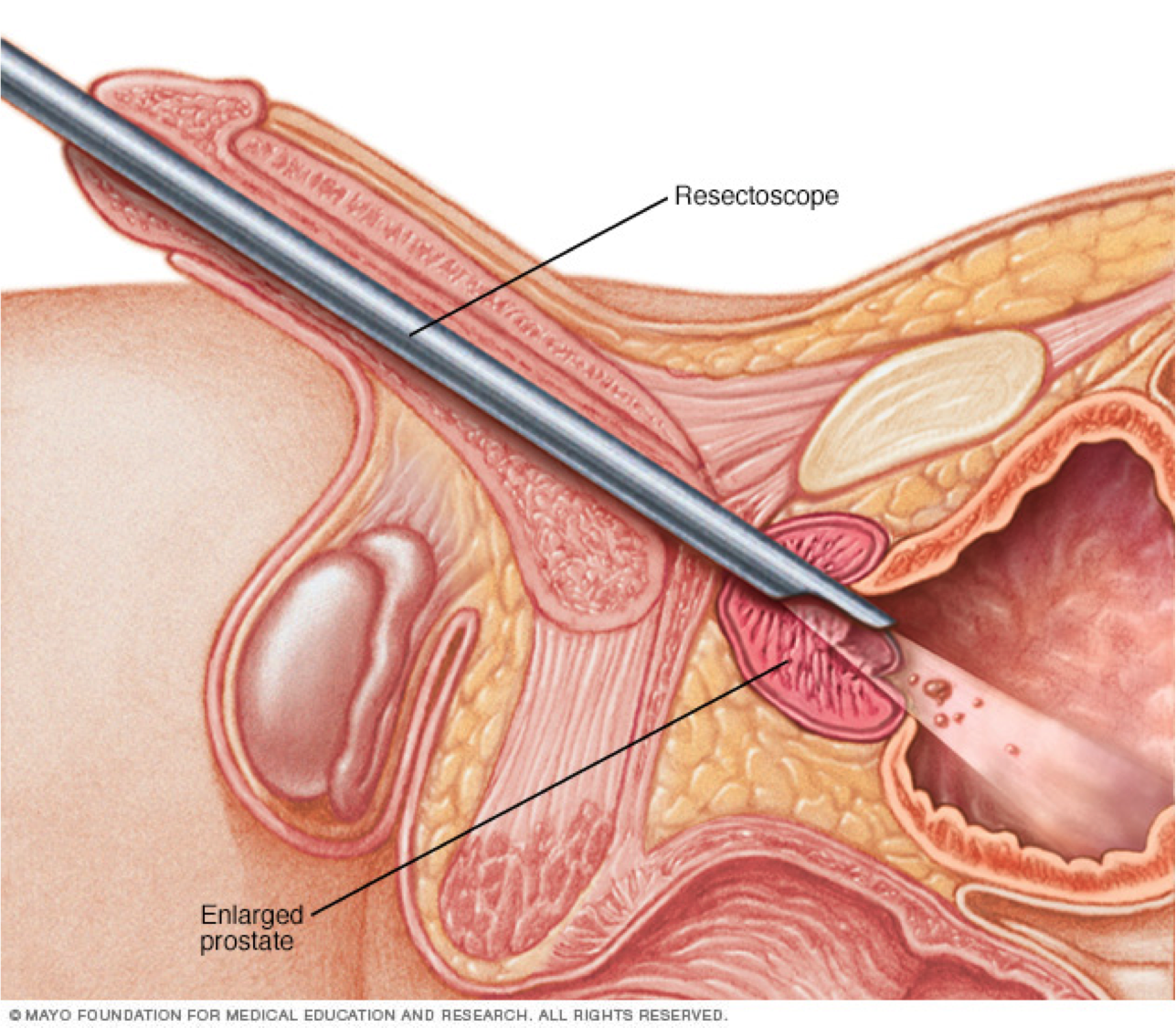 tumor benigno prostata operacion