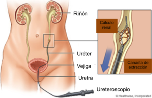 Ureteroscopia + endolitotripsia con laser